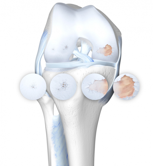 Arthrose_4Details.jpg