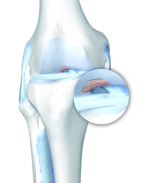 Knorpelschaden-im-Knie_Osteochondrosis-dissecansDetail.jpg